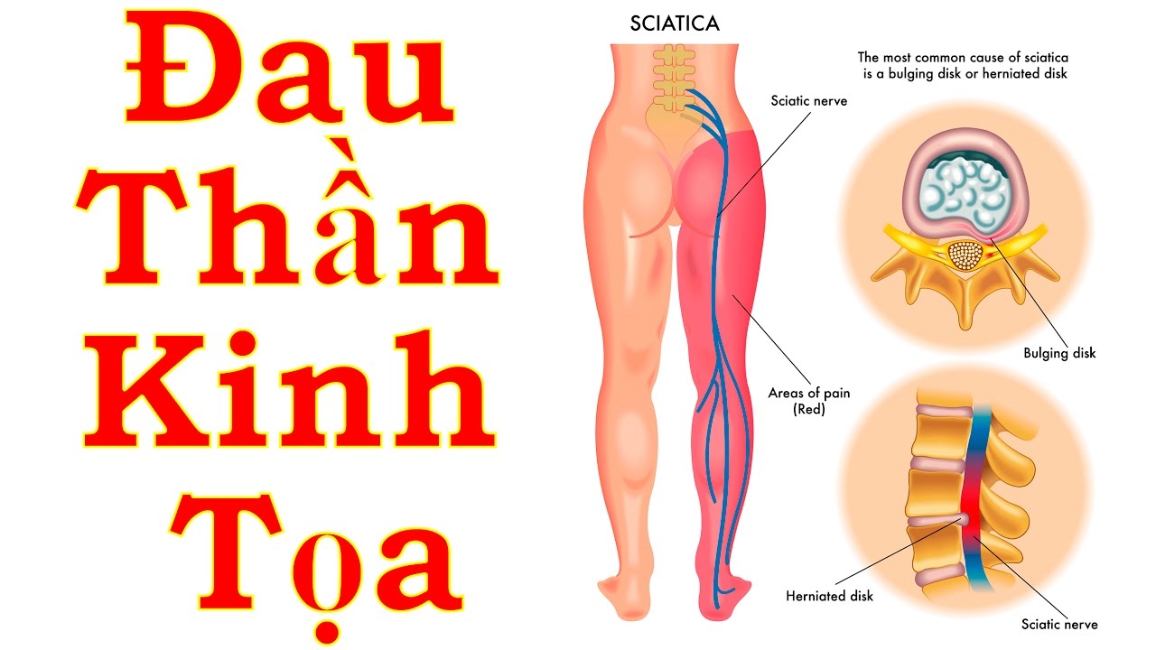 Sciatica anal burning