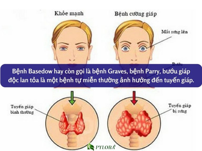 Triệu chứng và dấu hiệu của bệnh basedow? 
