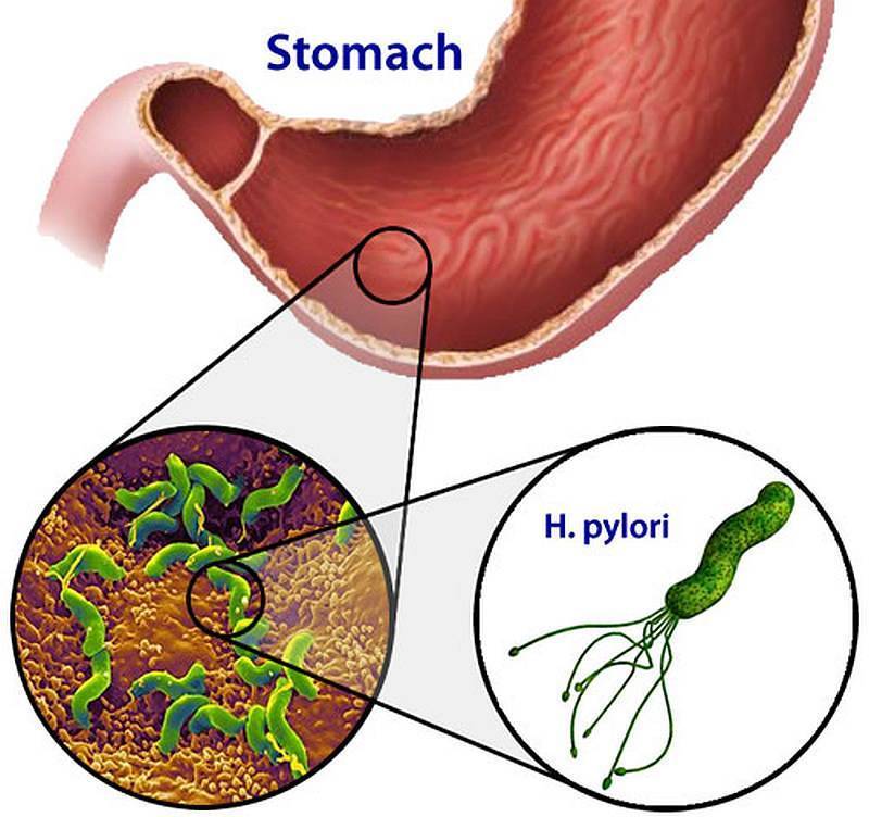 Причины появления бактерий в желудке. Язва желудка бактерия хеликобактер. Хеликобактер пилори язвенная болезнь. Хеликобактер пилори язва. Язва желудка хеликобактер.