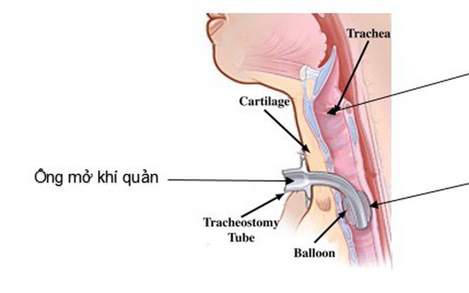 Mô hình đặt nội khí quản  Thiết bị y tế Huê Lợi