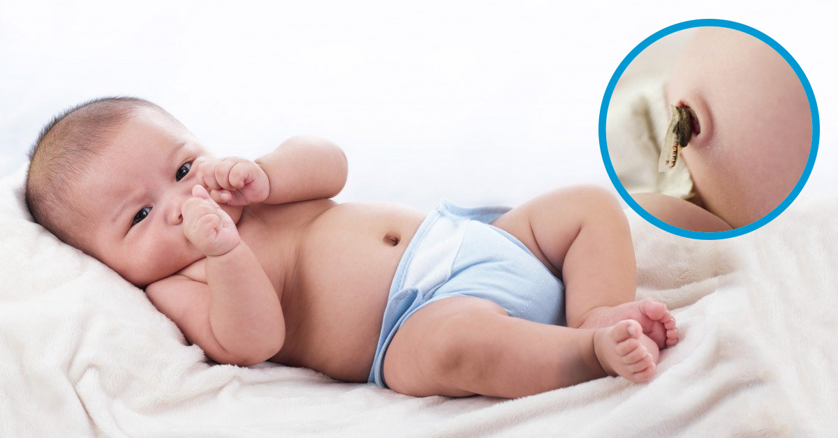 Trẻ sơ sinh bị nhiễm trùng rốn nên xử lý như thế nào?