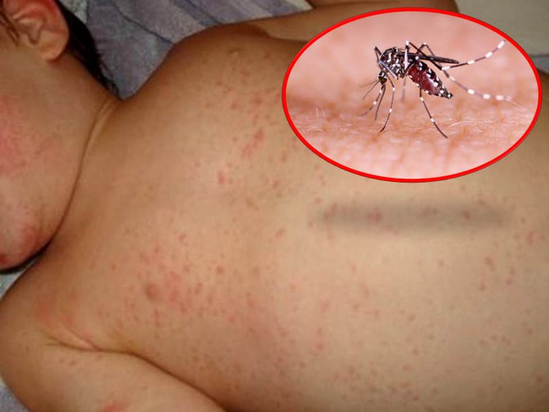 Hình ảnh bệnh sốt xuất huyết ở trẻ em