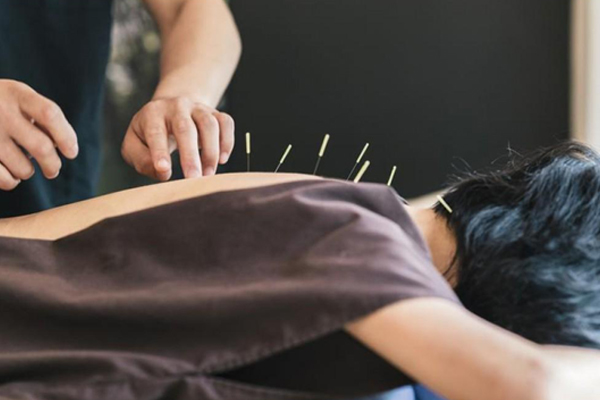 Quy trình kỹ thuật châm cứu
