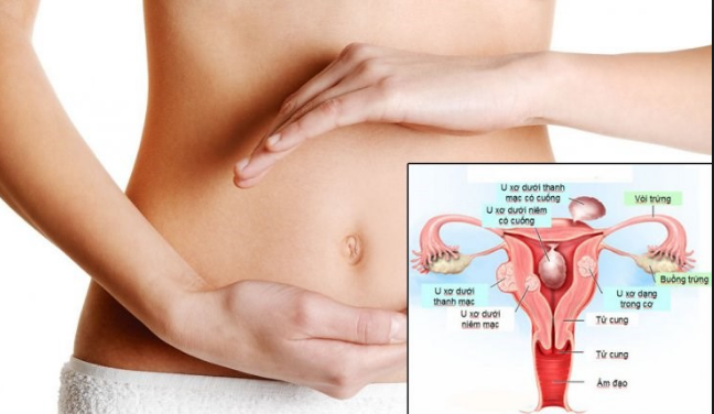U xơ cổ tử cung ở phụ nữ