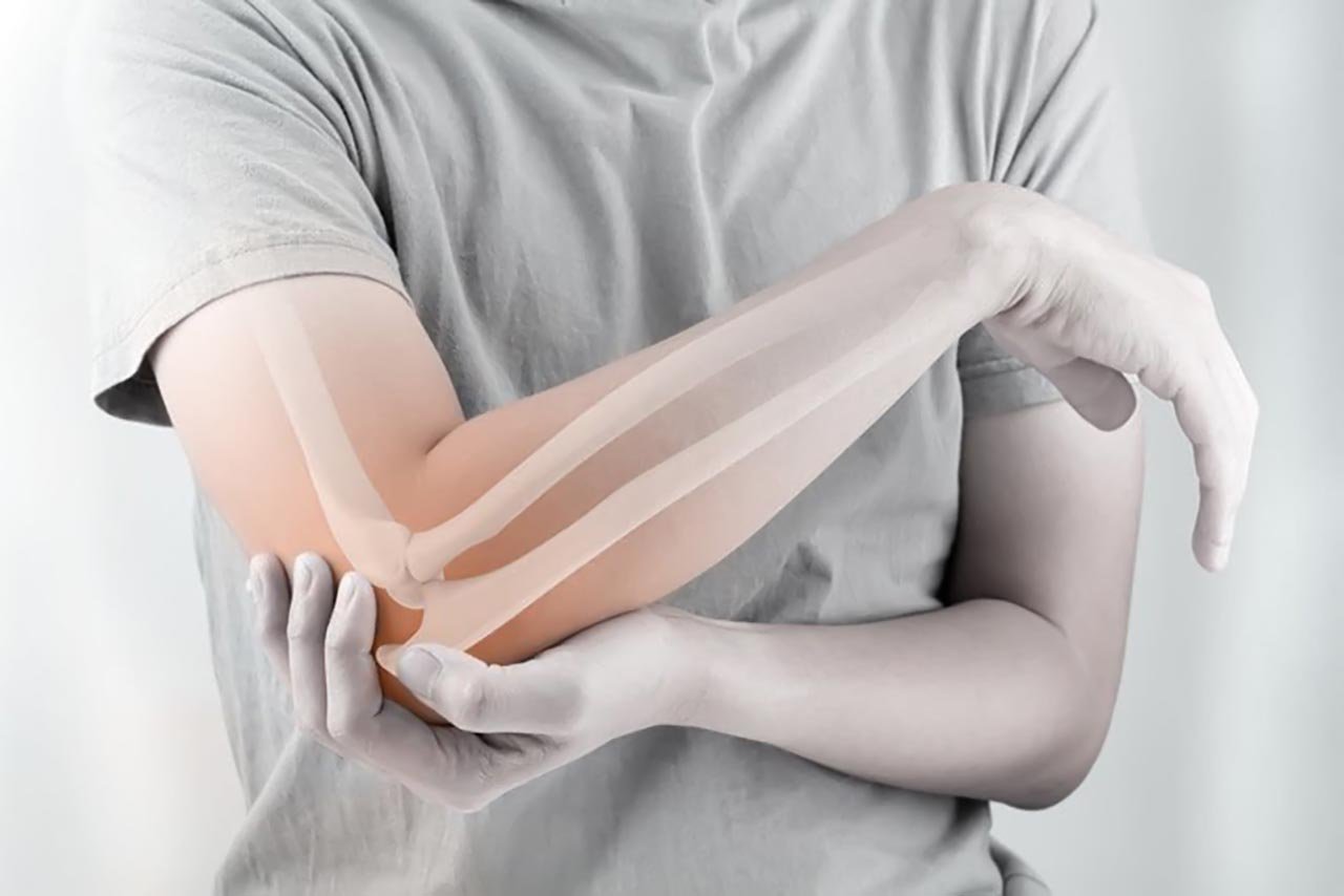 Phục hồi chức năng sau gãy xương khuỷu tay như thế nào