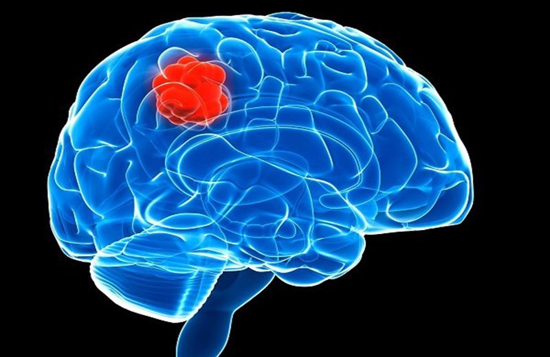 Tổn thương chức năng não bộ dễ xảy ra ở người cao tuổi
