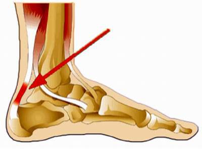 Đứt gân gót chân ảnh hưởng đến khả năng đi lại của người bệnh