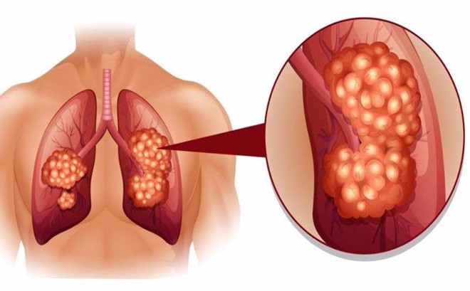 Bệnh Ung thư phổi là gì?
