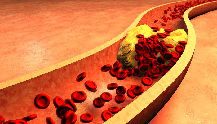 Xét nghiệm Lipid máu phòng ngừa các bệnh về máu an toàn