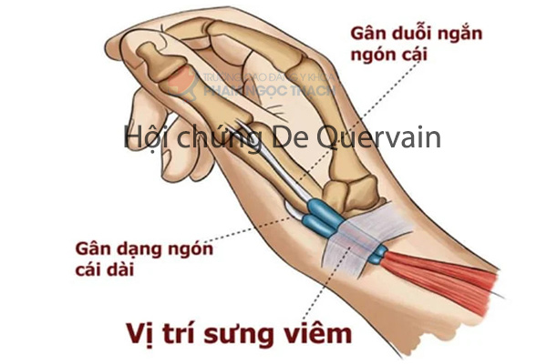 Hội chứng De Quervain sau sinh khiến đau khớp cổ tay