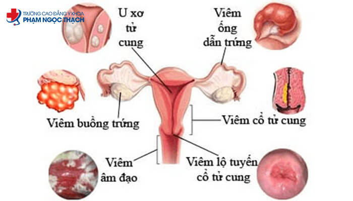 Hình ảnh Các bệnh Phụ khoa thường gặp ở nữ