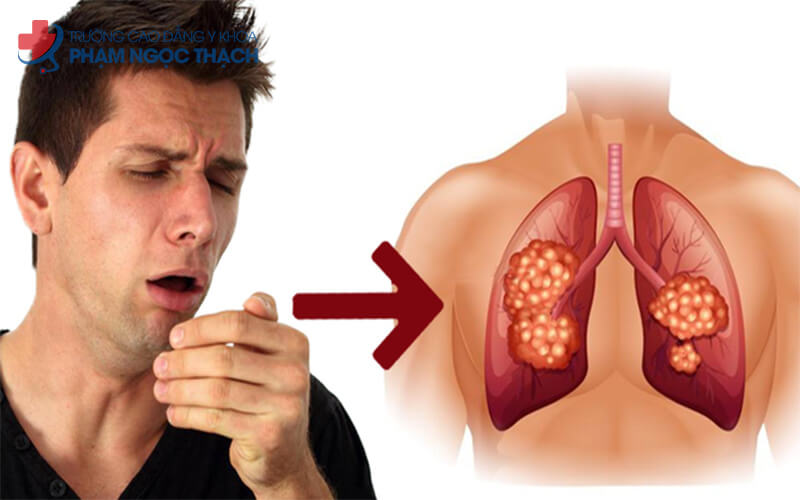 Ho dai dẳng kéo dài là dấu hiệu nhận biết Ung thư phổi sớm