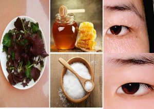 Chữa mụn thịt quanh mắt tận gốc bằng phương pháp dân gian