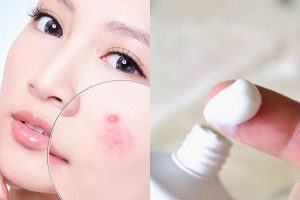 Tổng hợp cách trị mụn đầu đen bằng kem đánh răng