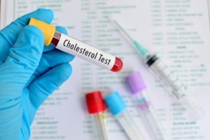 Xét nghiệm Cholsesterol là gì? Cách đọc chỉ số xét nghiệm Cholesterol