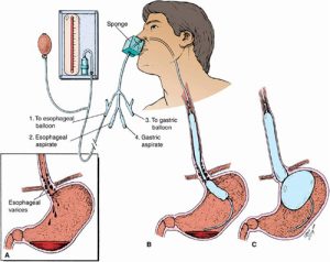 Cách thực hiện kỹ thuật đặt sonde dạ dày