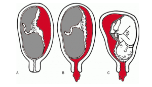 Canxi hóa là gì? Có nguy hiểm đối với thai nhi không?