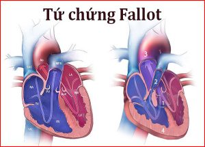 Nguyên nhân, triệu chứng, phương pháp điều trị tứ chứng fallot