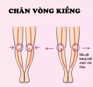 Chân vòng kiềng như thế nào? Có chữa khỏi được không?