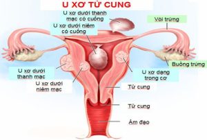 Nhân xơ tử cung là gì? Bệnh có nguy hiểm không?