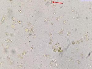 Bênh lỵ amip là gì? Nguyên nhân, triệu chứng và cách điều trị