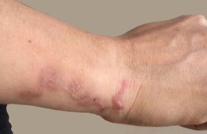 Lợn gạo là gì? Ăn thịt lợn gạo có sao không?