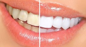 Bật mí các cách làm trăng răng tại nhà ngay lập tức sau 2 phút