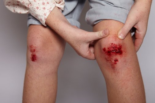 vết thương bị nhiễm trùng