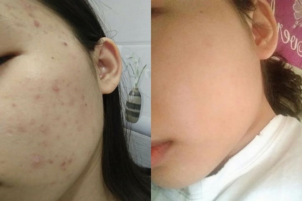 C&aacute;ch d&ugrave;ng Klenzit MS v&agrave; Derma Forte theo chỉ định của b&aacute;c sĩ