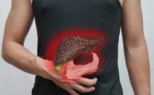 Sỏi mật là gì? Chữa sỏi mật có được không?