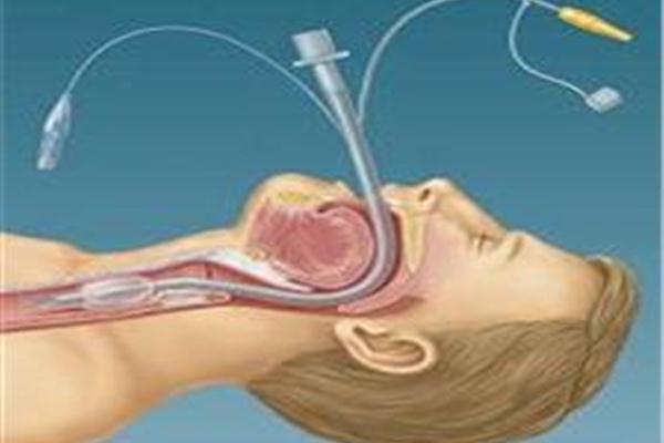Hướng dẫn chăm sóc người đặt nội khí quản cho người bệnh