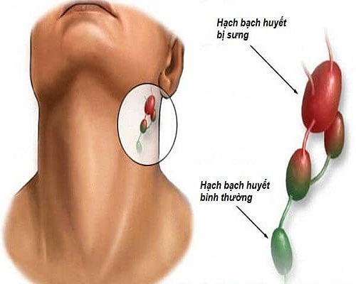 Bệnh ung thư thực quản giai đoạn cuối cực kỳ nguy hiểm