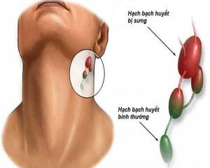 Kinh nghiệm chăm sóc bệnh nhân ung thư thực quản giai đoạn cuối