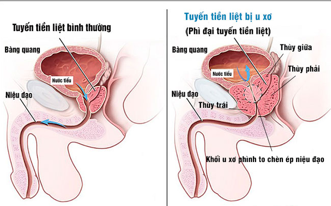 Phẫu thuật u xơ tiền liệt tuyến khi nào