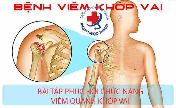 Học Kỹ thuật Phục hồi Chức năng vi&ecirc;m quanh khớp vai