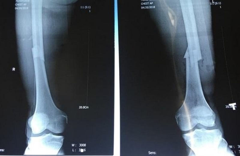 H&igrave;nh ảnh g&atilde;y xương ch&agrave;y phổ biến