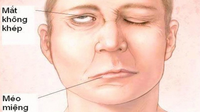 Liệt 7 ngoại bi&ecirc;n g&acirc;y m&eacute;o mặt l&agrave; t&igrave;nh trạng phổ biến