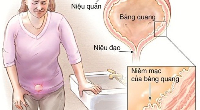 Tiểu tiện kh&ocirc;ng tự chủ cần phải qua b&agrave;i tập phục hồi chức năng