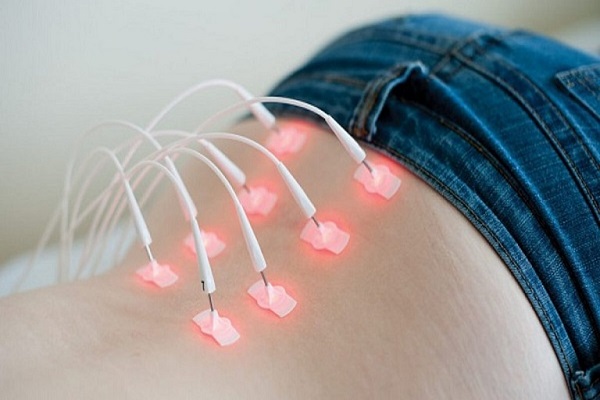 Phương ph&aacute;p nhiệt trị liệu phục hồi chức năng đau thần kinh tọa