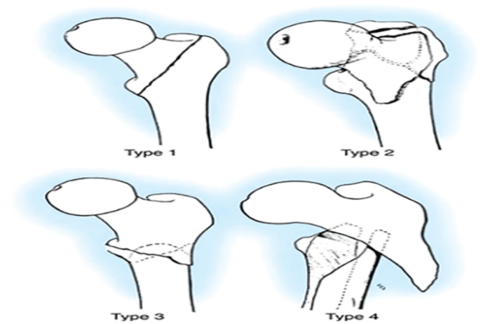 T&igrave;nh trạng g&atilde;y li&ecirc;n mấu chuyển dễ gặp phải ở nữ giới