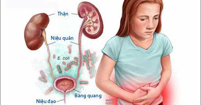 Phục hồi chức năng rối loạn cơ tr&ograve;n cho bệnh nh&acirc;n