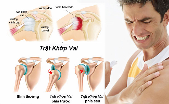 Trật khớp vai cần được phục hồi chức năng sớm