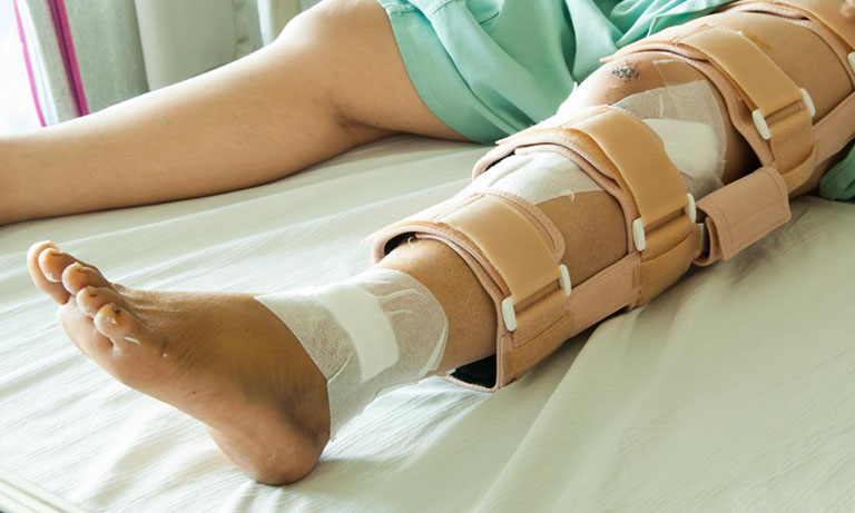 Bài tập Phục hồi Chức năng vỡ xương bánh chè an toàn, hiệu quả