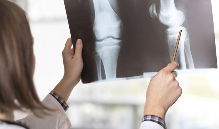 Vỡ xương bánh chè khá nguy hiểm với bệnh nhân