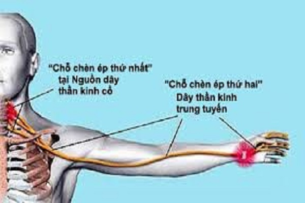 T&igrave;m hiểu về t&igrave;nh trạng d&acirc;y thần kinh quay như thế n&agrave;o