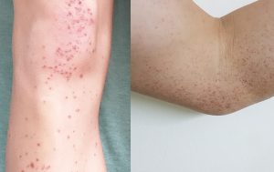 Bệnh viêm mao mạch dị ứng là gì? Cách điều trị như thế nào?