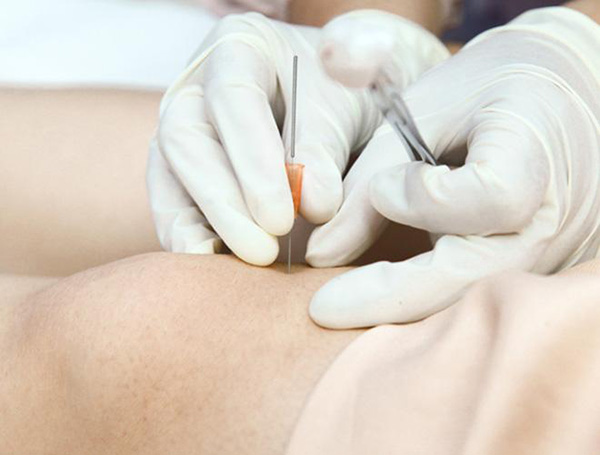 Cấy chỉ là phương pháp kết hợp giữa châm cứu truyền thống với khoa học hiện đại