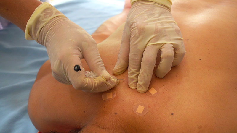 Những người mệt mỏi, mắc các bệnh ngoài da không nên thực hiện cấy chỉ