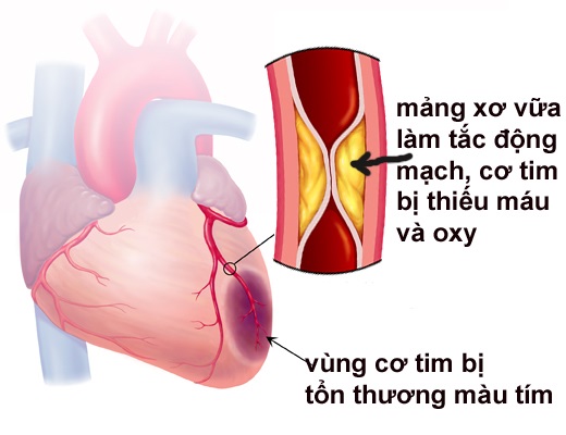 Hướng dẫn chăm s&oacute;c bệnh nh&acirc;n nhồi m&aacute;u cơ tim an to&agrave;n