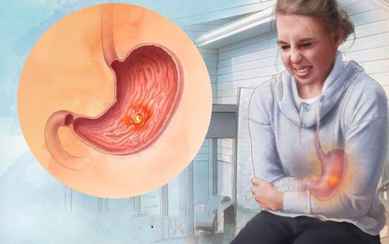 Thủng dạ d&agrave;y c&oacute; thể g&acirc;y nguy hiểm đến sức khỏe người bệnh